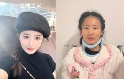 蔡磊回应26岁渐冻症女孩离世