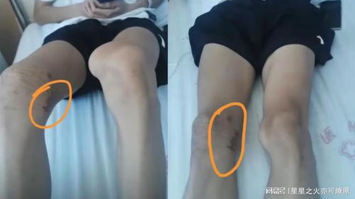 体育生被错切右膝 母亲:不接受和解 体育生被错切右膝 母亲:不接受和解
